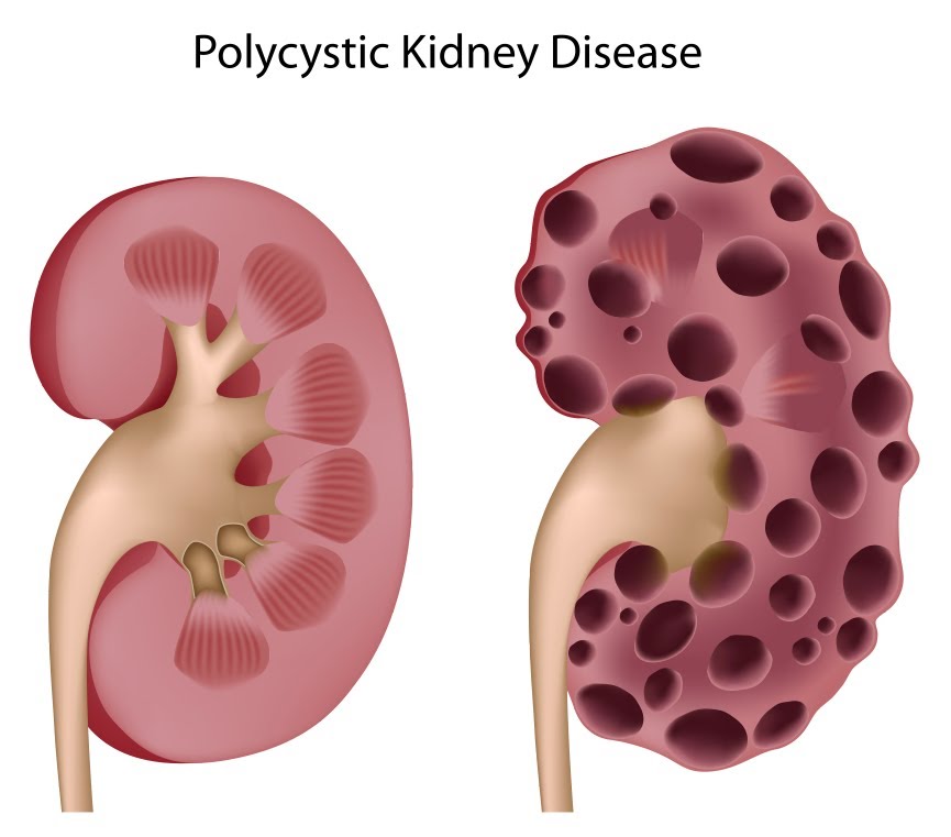 ALBUMINURIA